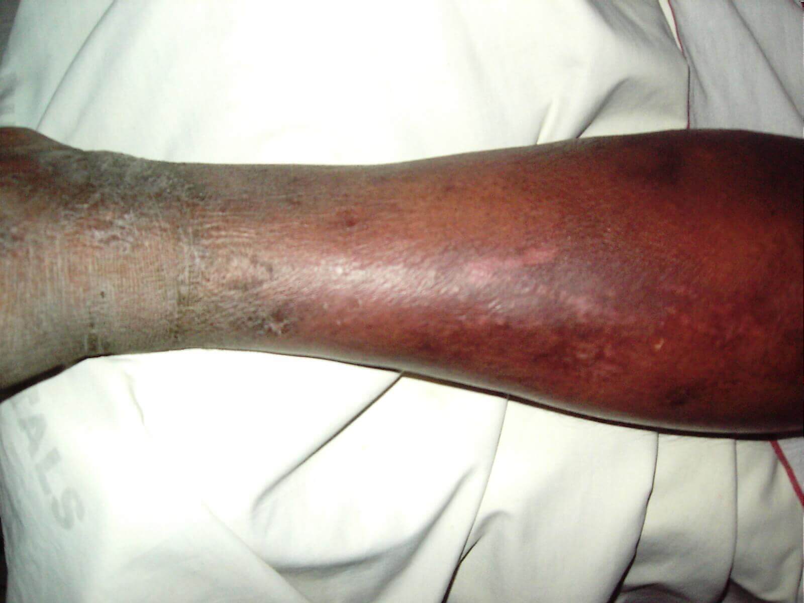 cellulitis risk factors