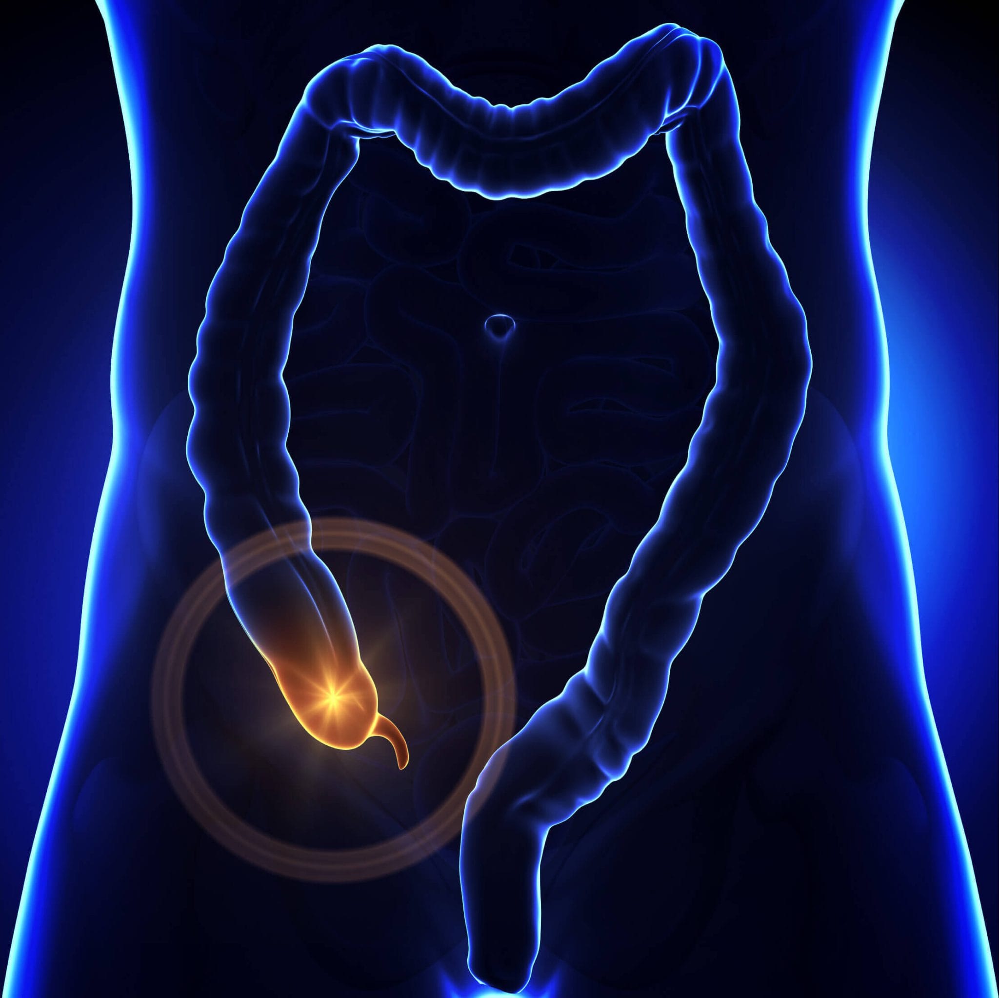 How to prevent appendicitis