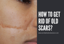How to get rid of old scars-woms
