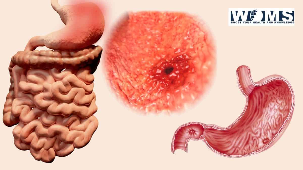 Signs of stomach ulcer