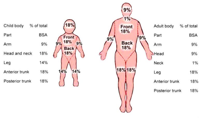 How to treat burn? [Principle of treatment] - Medical blogs for students