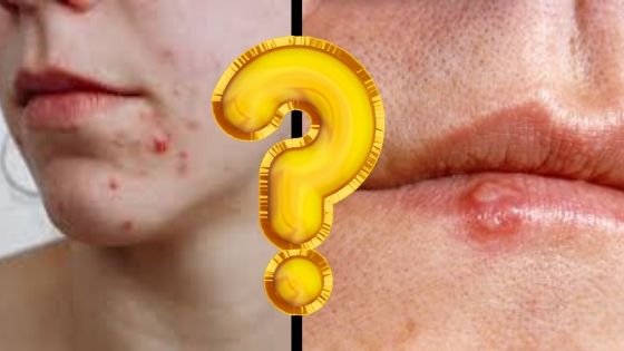 pimple vs cold sore 