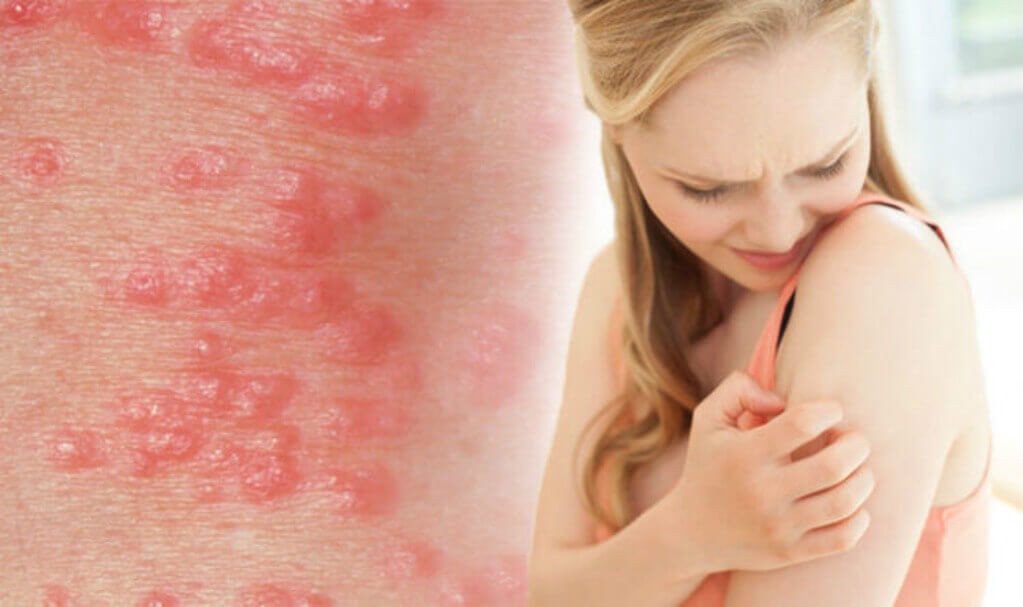 scabies signs and symptoms