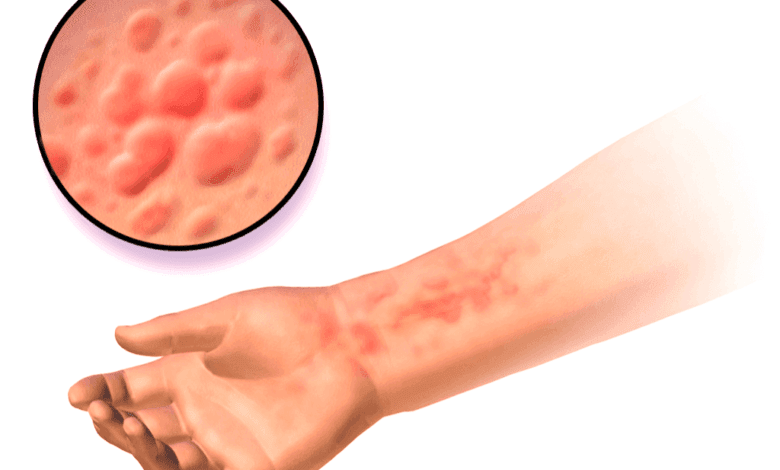 causes of hives