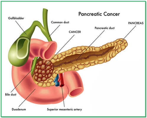 Adenocarcinoma of the pancreas