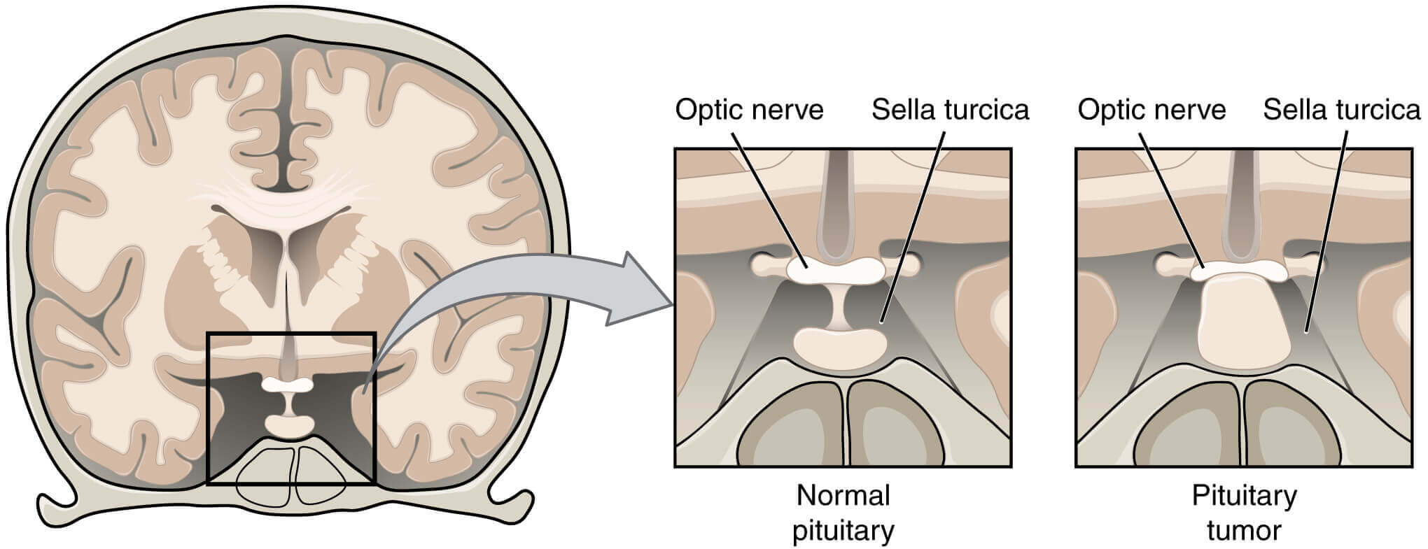 Pituitary tumour