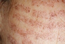 Laser hair removal burns