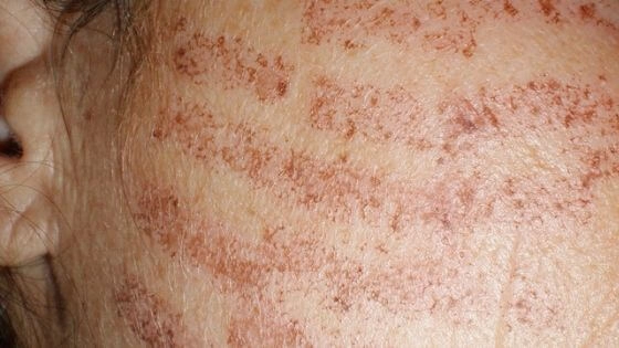 Laser hair removal burns: causes, symptom and treatment