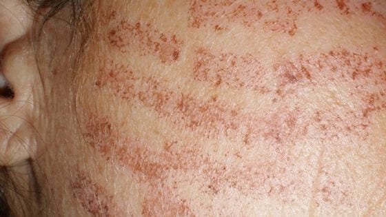 Laser hair removal burns