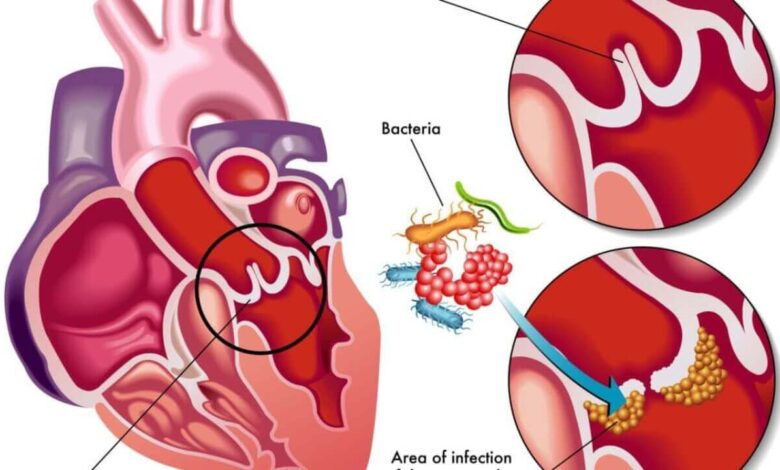 How Is Bacterial Endocarditis