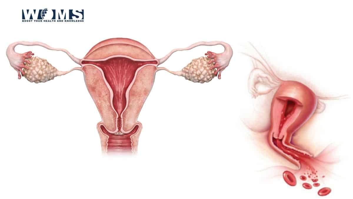 dysfunctional-uterine-bleeding-pathalogy-investigations-management