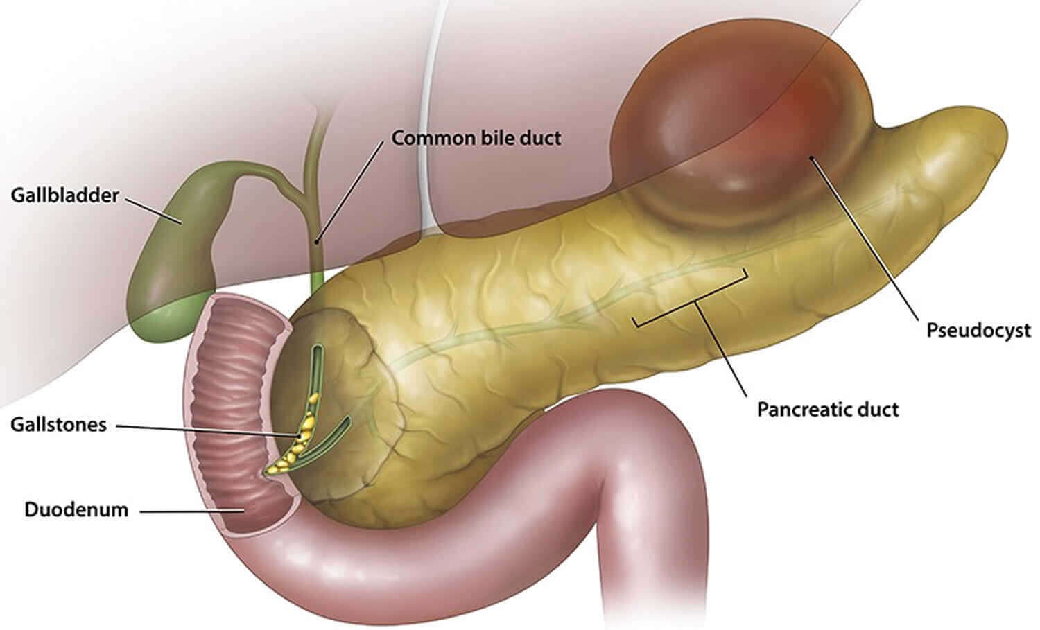 Pseudocyst of pancreas