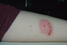 Spider bite symptoms