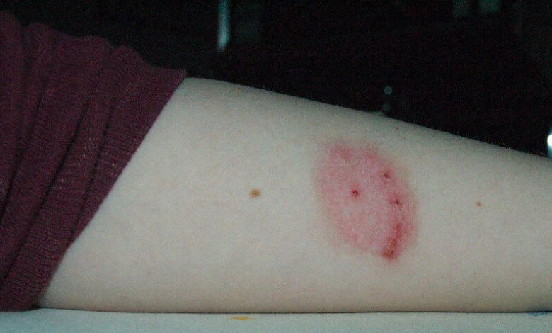 What Does A Spider Bite Look Like In The Beginning / Spider Bites Black Widow Vs Brown Recluse First Aid : Like other bug bites, a spider bite is also typically itchy and/or painful.