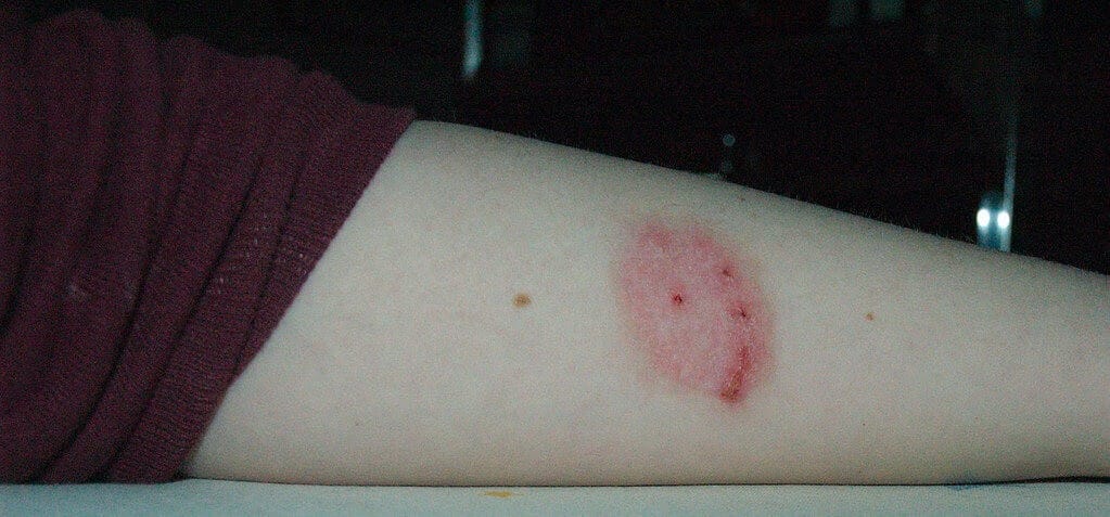 ground spider bite symptoms