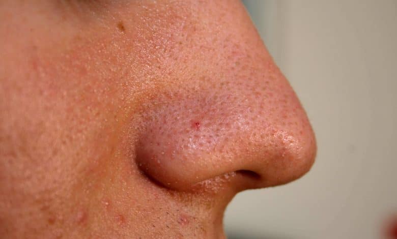 blackheads on nose