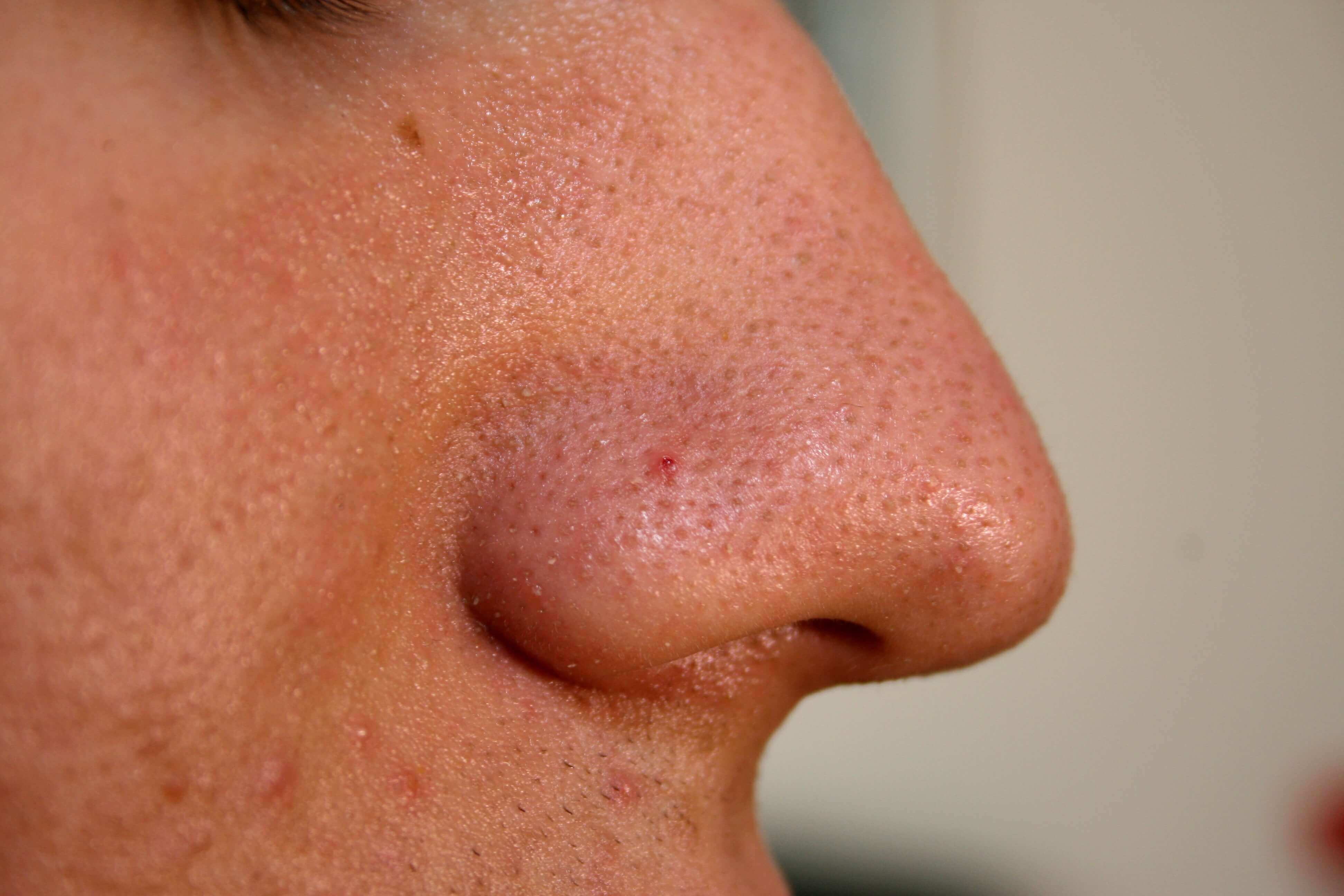 HOW TO GET RID OF BLACKHEADS ON NOSE AND CHIN