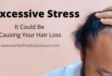 Excessive Stress: It Could Be Causing Your Hair Loss