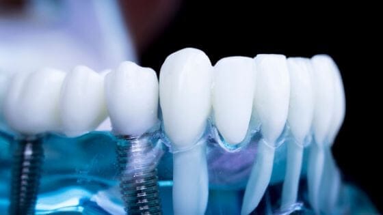 Dental Implants