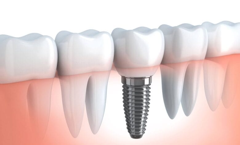 Contemplating on Dental Implants