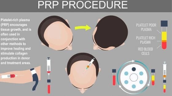 PRP Treatment