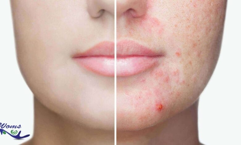 Acne spot treatment