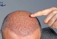 Best hair transplant