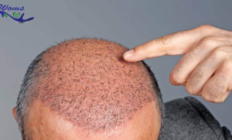 Best hair transplant