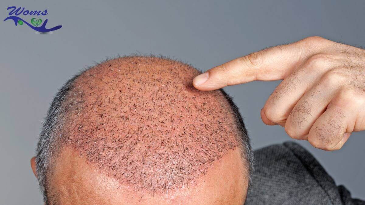 Best Hair Transplant Everything You Need To Know About It WOMS