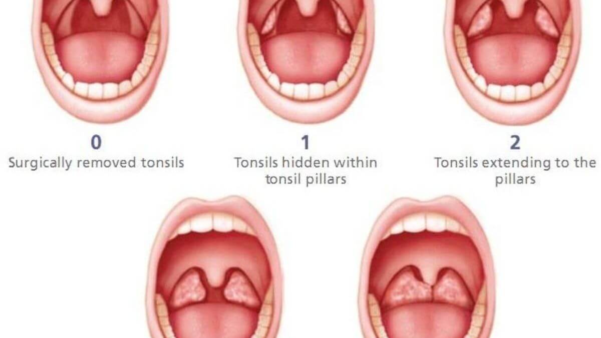 What Is Stage 3 Tonsil Cancer