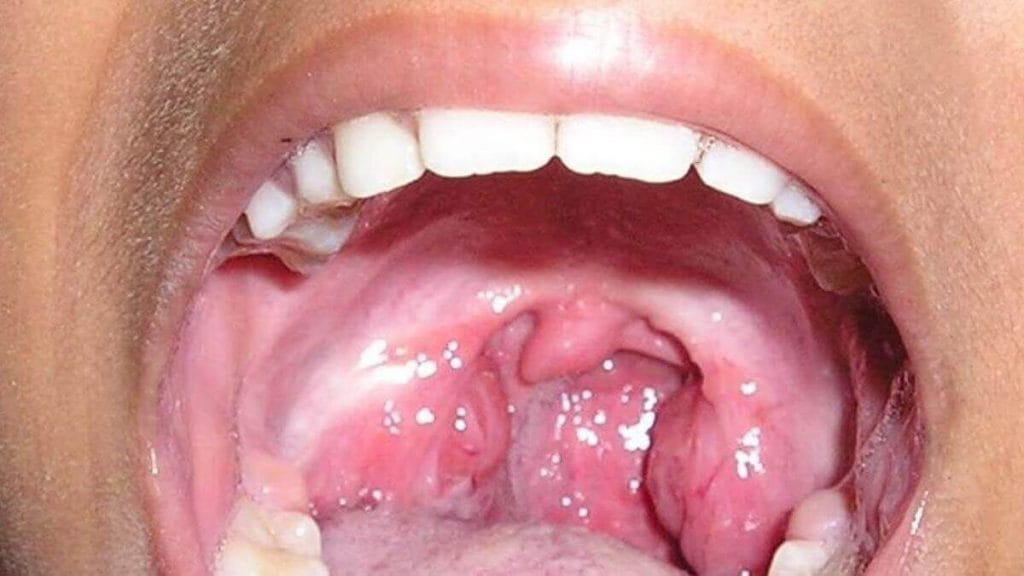 Tonsil Cancer: Causes, symptoms, prognosis & treatment-WOMS