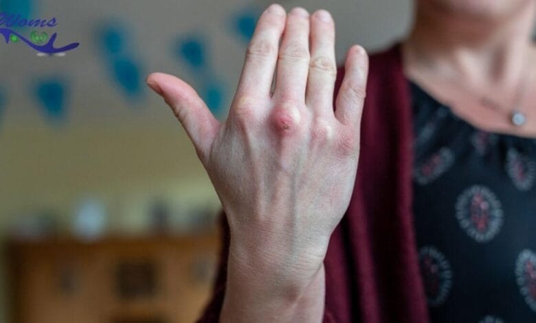 Burning hands side effects