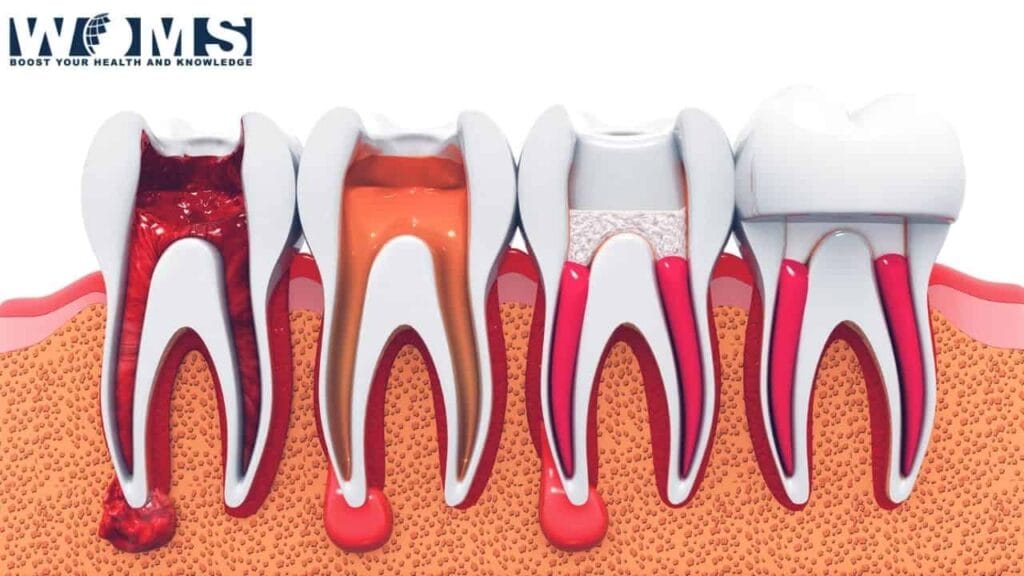 Root Canal Therapy; How long does a root canal take? WOMS