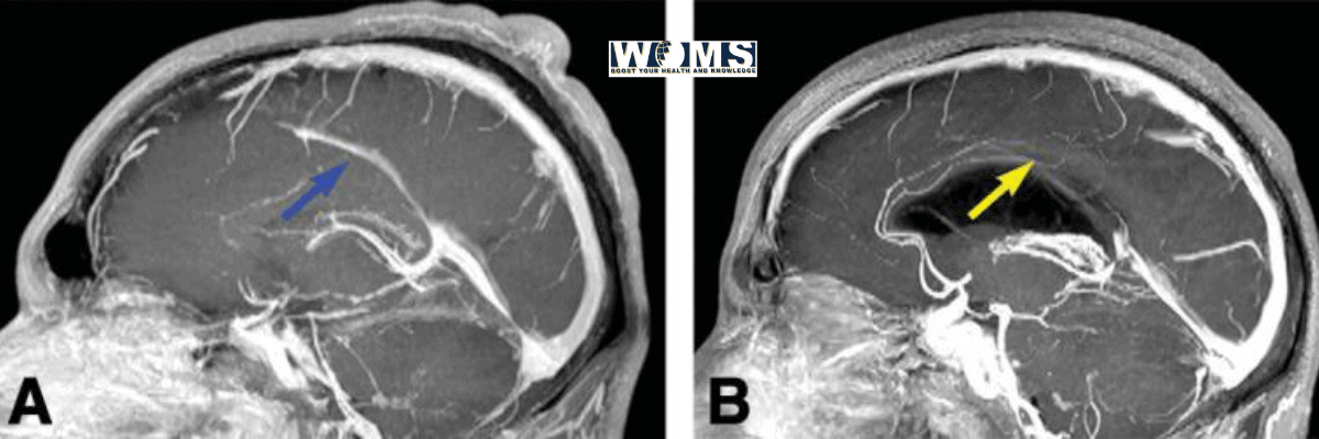 Normal As Well As Variant Anatomy Of The Dural Venous Sinuses Woms 7442