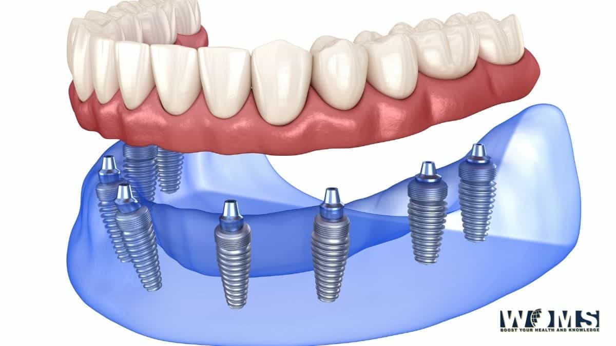 what are dental implants