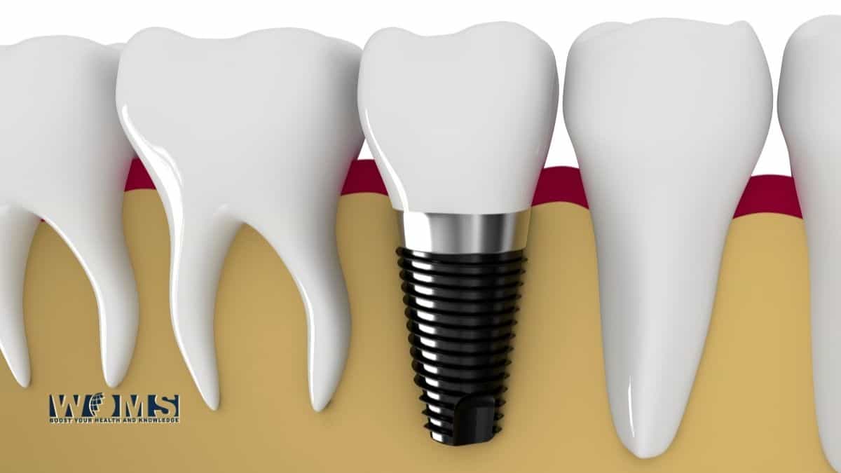 dental implants houston