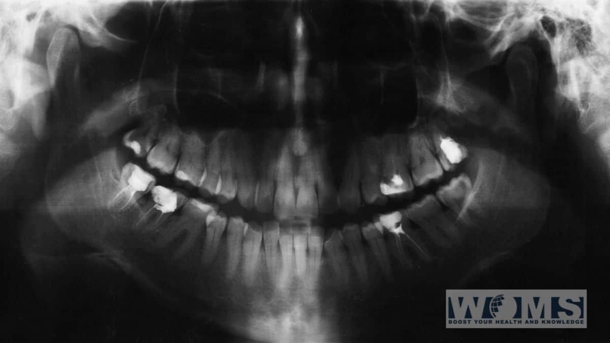 Baby teeth X-ray