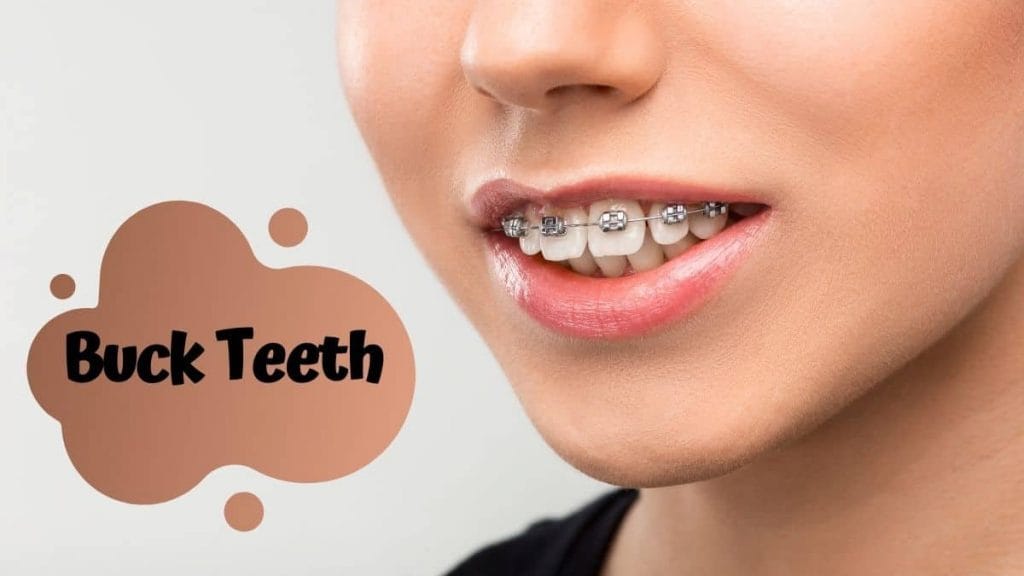 Overbite or Buck Teeth WOMS