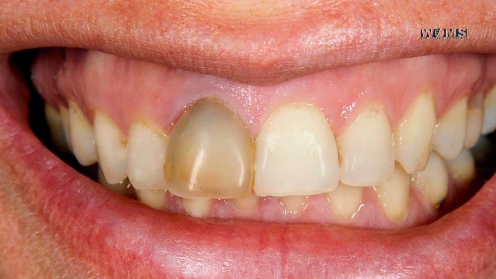 Dead Tooth How to Prevent it? WOMS