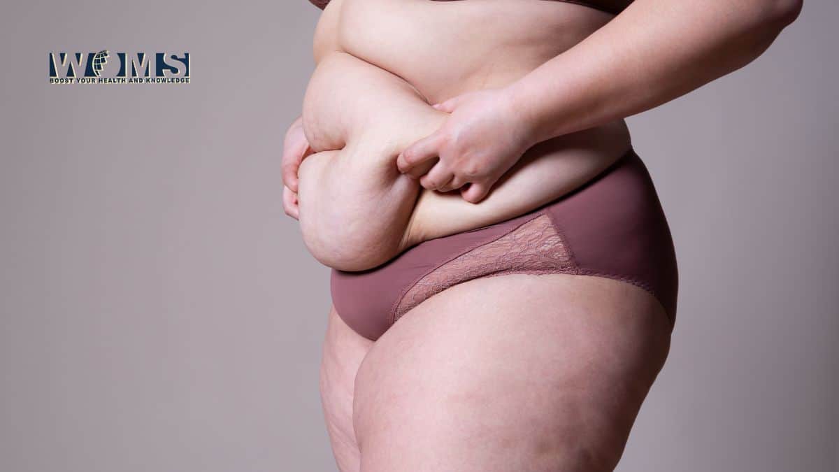 Abdominoplasty