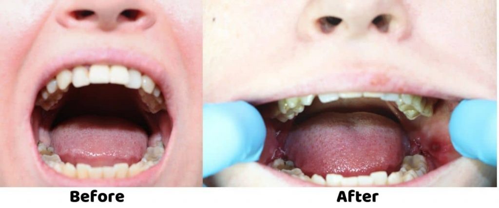 wisdom teeth stitches before and after