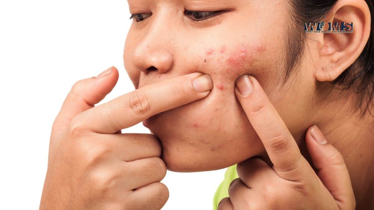 What are the Causes of Acne