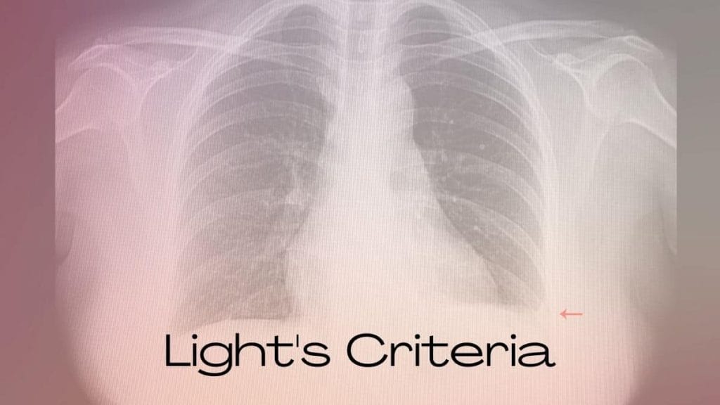 What are Light's Criteria? WOMS