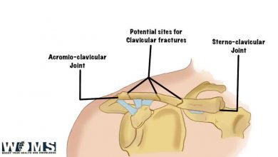 Types of Clavicle Fracture