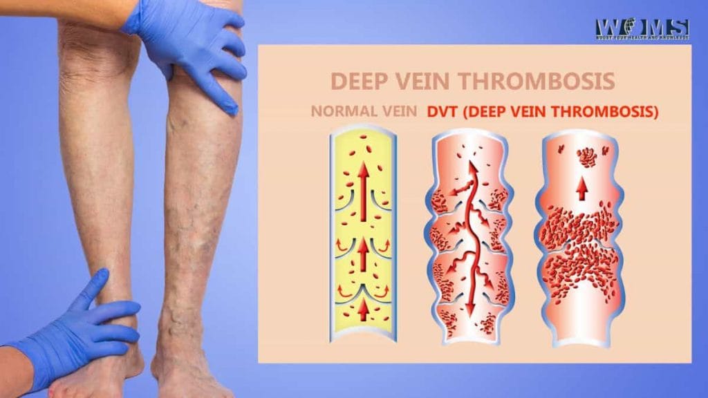 What Are the Dangers of Deep Vein Thrombosis (DVT)? WOMS