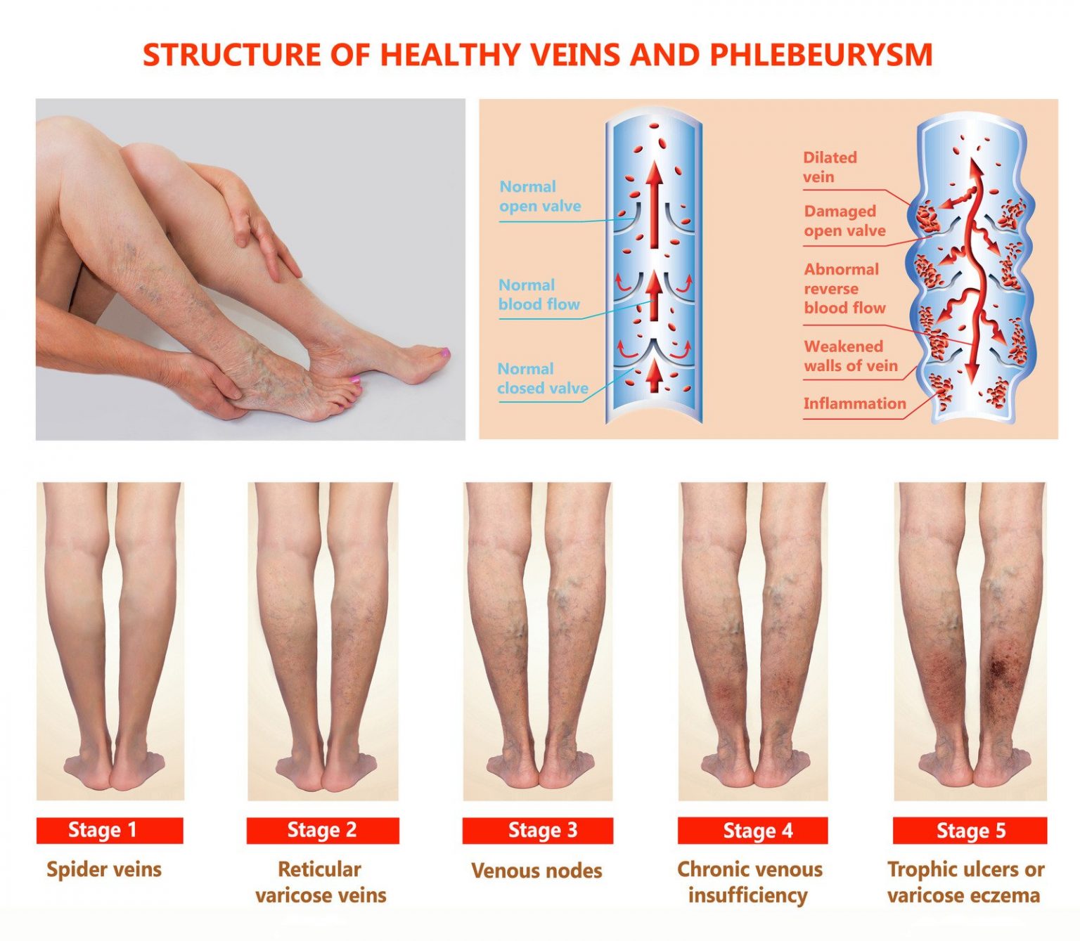 What Are the Dangers of Deep Vein Thrombosis (DVT)? - WOMS