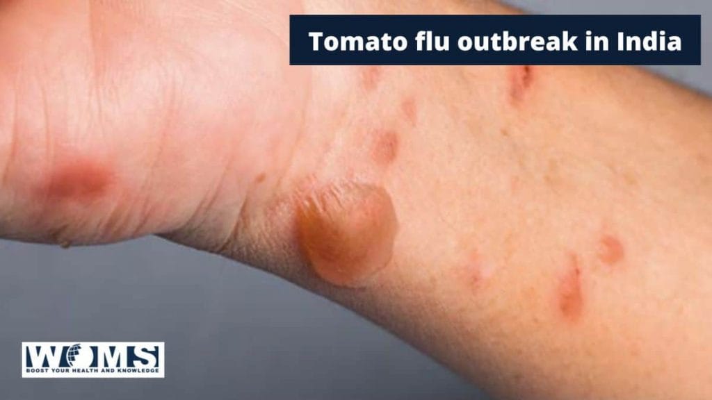 Tomato Flu Outbreak In India WOMS
