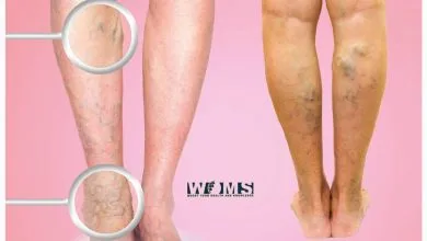 Varicose Veins