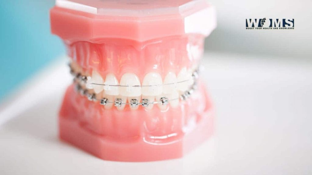 5 Best Brace Alternatives You Should Consider WOMS