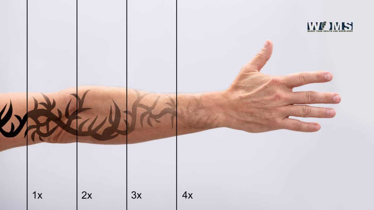 Laser Tattoo Removal Results For Los Angeles Patients